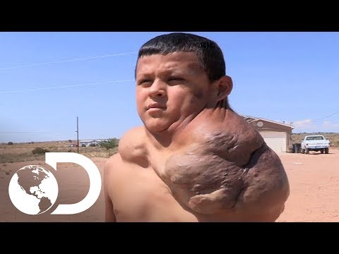 Vídeo: Um Menino Tartaruga Teve Um Enorme Tumor Removido Em Suas Costas - Visão Alternativa