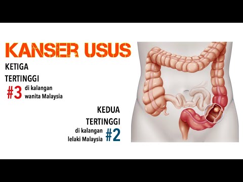 Apa Itu Kanser Usus | Punca Kanser Usus | Tanda Awal Kanser Usus | Cara Cegah Dan Rawat Kanser Usus