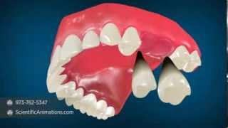 Nance Appliance - Orthodontist