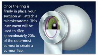 Lasik Eye Surgery in Knoxville