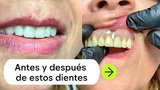 El antes y después de esta prótesis dental Acrílica te va a encantar 😃