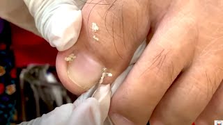 How to Repair Nails easy # 446 - Xuyen Nail