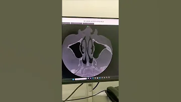 Cbct Upper Jaw Maxilla Video Cbct 3d 3d 2d Trending Ctscan Dental 
