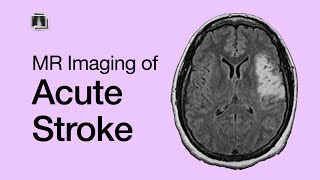 Brain MRI in Stroke