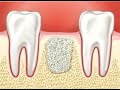 Имплантация зубов при недостаток костной ткани. Костная пластика в стоматологии Диалог