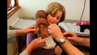 Exitosa Cirugía A Niña Con Cuatro Piernas Y Dos Columnas