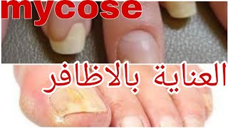 شوفو كيكانو وكيولو?comment traiter une mycose des ongles ? remède facile ? champignons ?مانيكورطبيعي