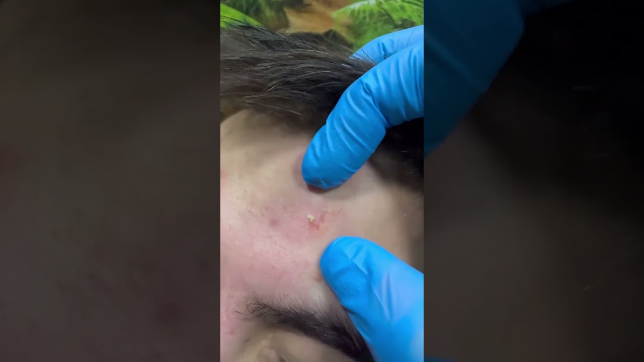 Blackheads Blackhead #blackheads #blackhead #pimples #pimplepopping #pimplepatch #acne #acnepatch