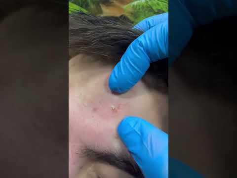 Blackheads Blackhead #blackheads #blackhead #pimples #pimplepopping #pimplepatch #acne #acnepatch