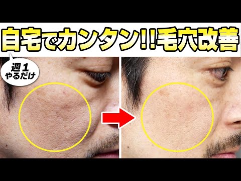 美顔ケノン5か月あてたら毛穴ボコボコごわつき肌がいい感じに改善