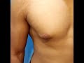 17 Y/O Male Puffy Nipples/Gland Gynecomastia for Removal Surgery by Dr. Lebowitz, Long Island, NY