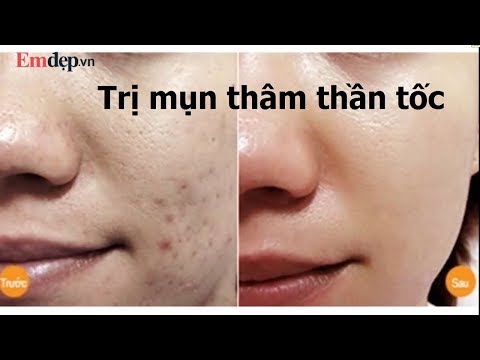 Thần dược TRỊ MỤN THÂM 'một phát ăn luôn' có giá chỉ vài nghìn đồng