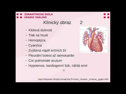 Video: Pulmonale Embolie Anticonceptie: Loopt U Risico?