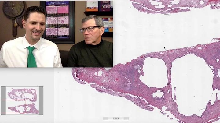 Pattern 2 – Fibrosis, UIP complicated by malignant mesothelioma (Top 25 Pearls Series, Bonus Case)