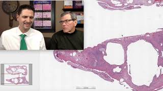 Pattern 2 – Fibrosis, UIP complicated by malignant mesothelioma (Top 25 Pearls Series, Bonus Case) Pattern 2 Fibrosis Uip