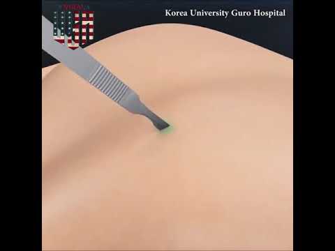 Minimal Invasive Scoliosis Surgery Animation
