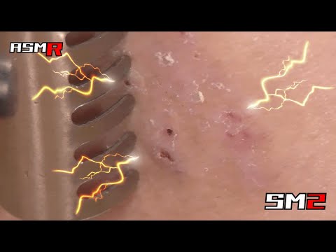【乾いたカリカリ音/アトピー性皮膚炎ASMR】超痒い皮膚を金属製の孫の手で掻く音/癒し/リラックス効果/睡眠導入/マッサージ