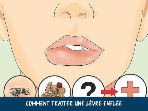 Vidéo: Comment soigner une lèvre enflée : 15 étapes (avec photos)