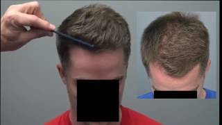 Hair Transplant Results - Strip After FUE in 4K Ultra HD!