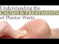 Understanding the Causes and Treatments of Plantar Warts