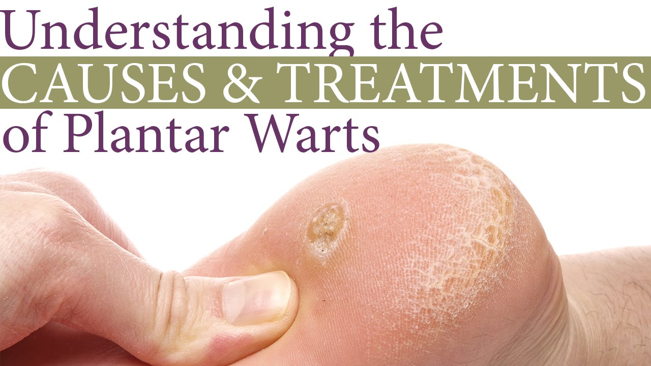 Anatomy Of A Plantar Wart