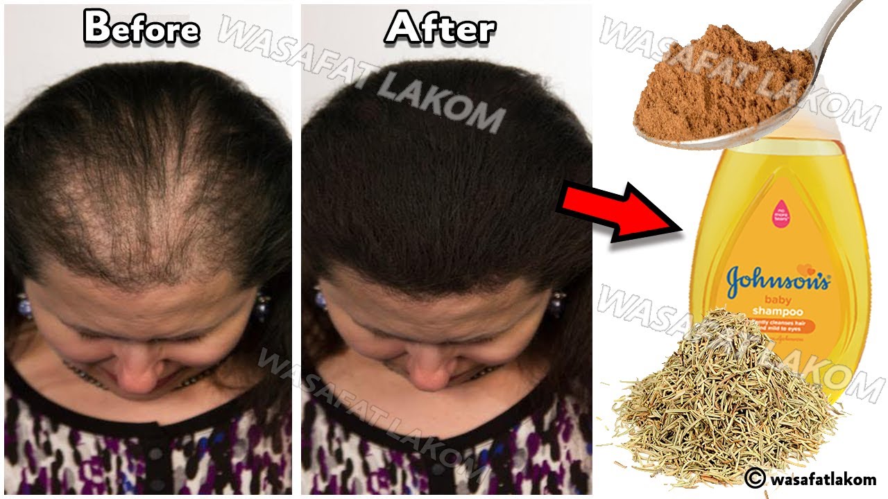 Put these ingredients in your shampoo, 🧅 it accelerates hair growth and