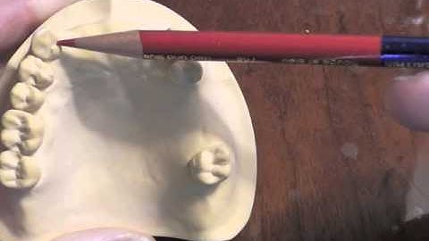 R P D Design - Ken Class III Max Dentoform Cast Part A