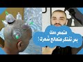 علاج تساقط الشعر والصلع الوراثي -  الحجامة لتساقط الشعر