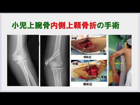 8分1秒）小児上腕骨内側上顆骨折の治療 - YouTube