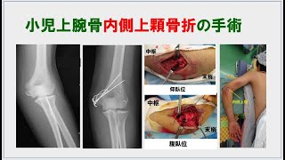 8分1秒）小児上腕骨内側上顆骨折の治療 - YouTube