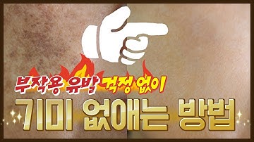 기미없애는법 잘못 시도하면 부작용으로 더 심해질수있습니다.