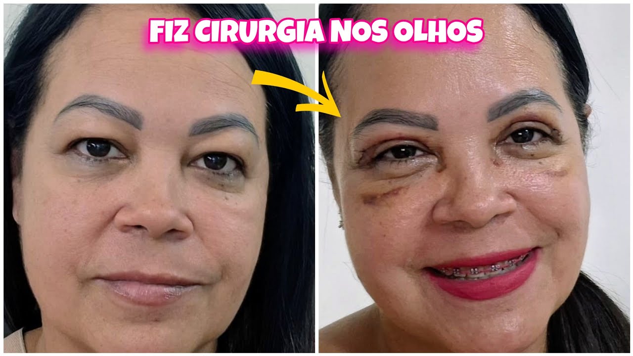 Fiz Cirurgia nos olhos  (BLEFAROPLÁSTIA) Meu  antes e Depois Real , Valeu a Pena ?