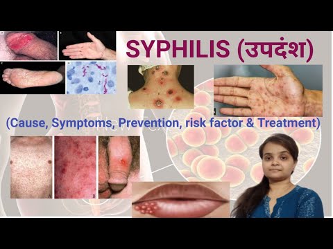 SYPHILIS (उपदंश),cause, symptoms, stages,risk factor, prevention & treatment llEASY TO UNDERSTANDll