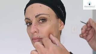 Full Face Toxin Markings with face map