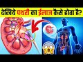 देखिये 3D में Kidney-Stone(पथरी) का ईलाज कैसे होता है? How to Remove Kidney Stones #shorts #ytshorts