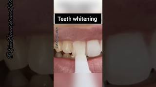 Magical Teeth Whitening At Home Instantly?| SM Beautyland studio shorts youtubeshorts