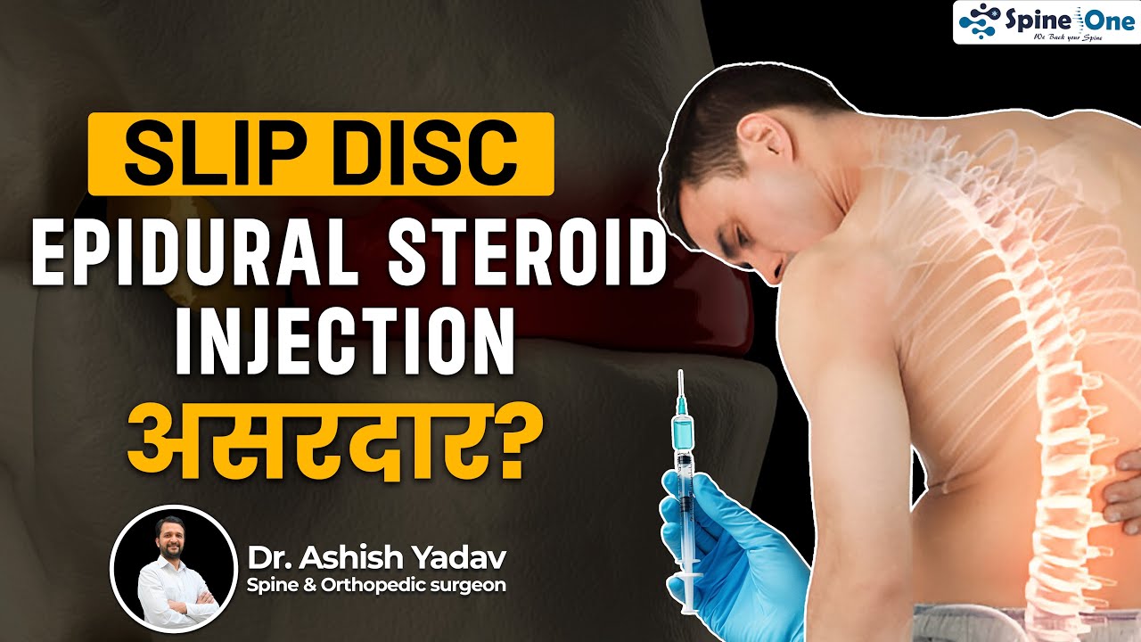 Slip Disc के लिए Epidural Steroid Injection - असरदार ? | Steroid ...