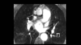Ascending aortic pseudoaneurysm after graft repair