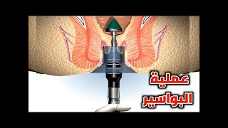 البواسير وتصحيحها بالعمليات