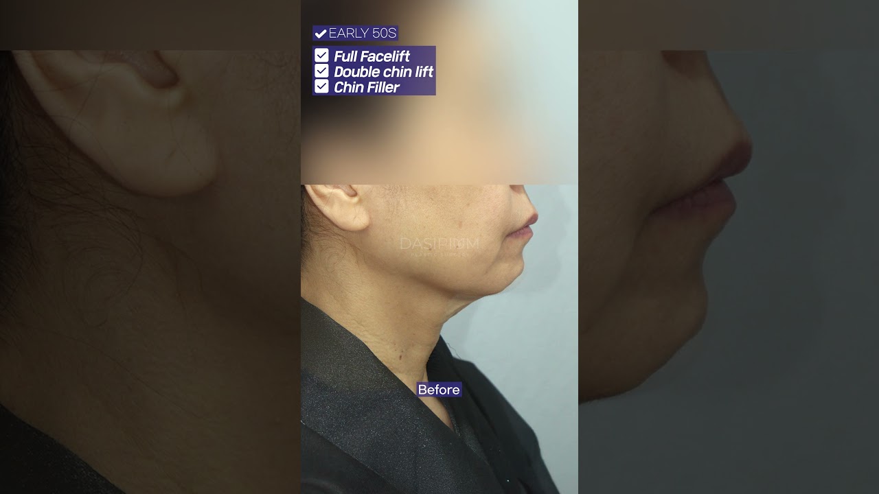 Double chin lifting and chin fillers 