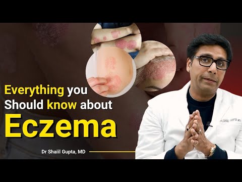 Eczema causes, symptoms, treatment | Eczema के कारण, इलाज  ( Hindi Video) | Dr Shaiil Gupta, MD