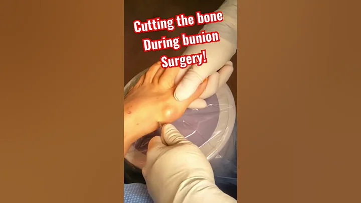 AMAZING BUNION SURGERY WITH TINY INCISION! 🤯