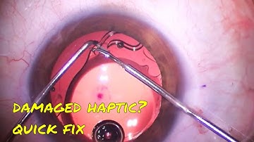 XCenter Technique: Fixing a Damaged haptic in a Toric Luxsmart Intraocular Lens
