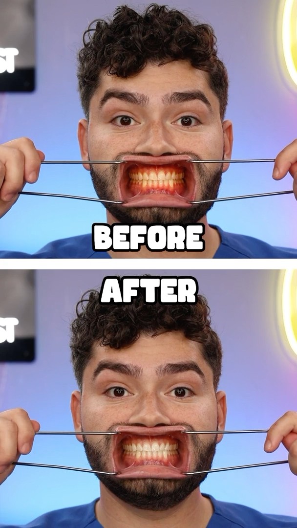 Teeth Whitening Hack !?