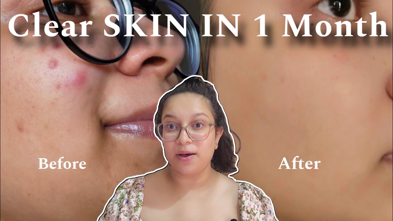 How i cleared my acne in 1 month | Shocking results | My Skincare ...