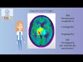 Tratamiento de los tumores cerebrales. INCMNSZ - Educación para la Salud