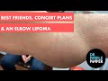 Best Friends, Concert Plans, & An Elbow Lipoma