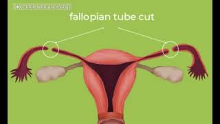 My Laparoscopic Bilateral Tubal Fulguration