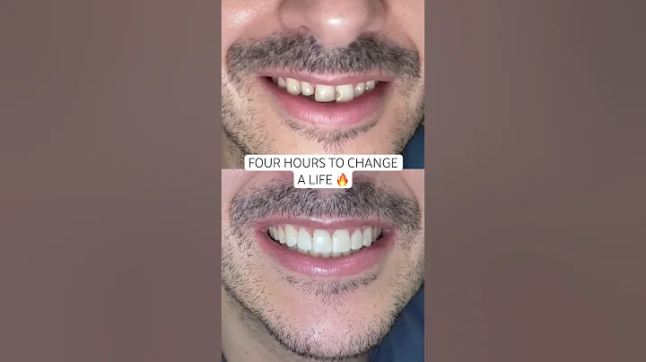 Composite bonding by Dr. Kunal. 🔥 #ruhdental #compositebonding