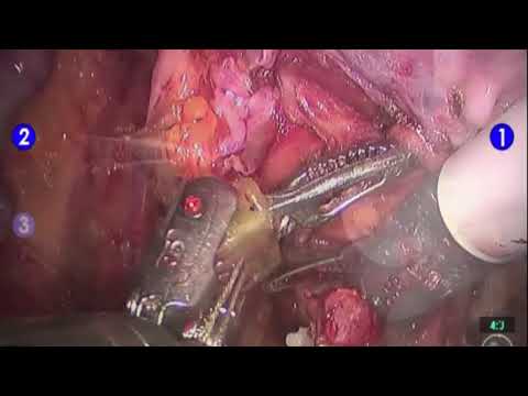 Robotic Female Radical Cystectomy Procedure  Brigham and Womens Hospital